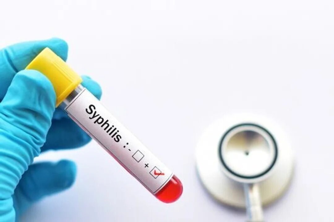 Сифилис в Аргентине достиг пятилетнего максимума