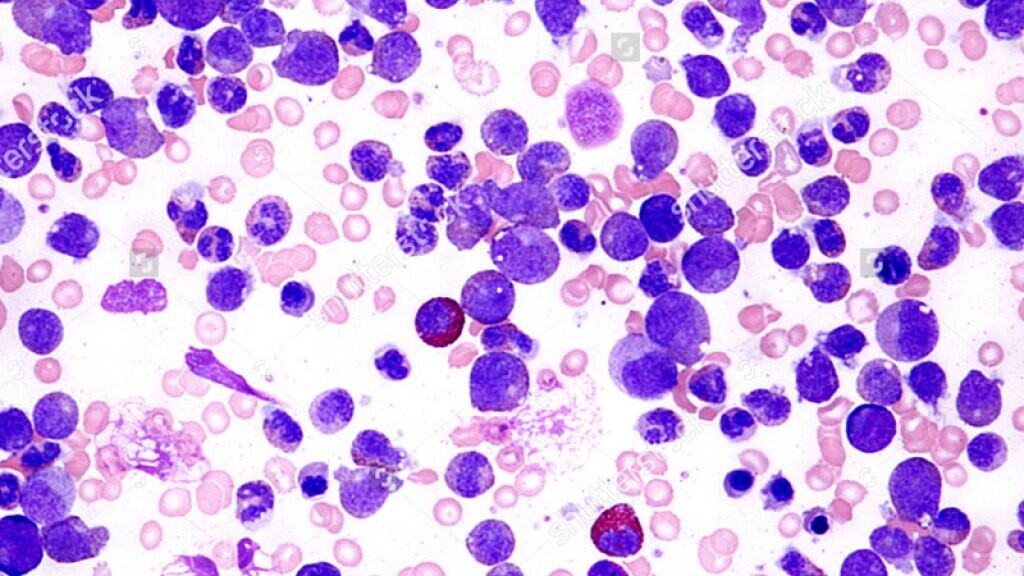 Mendoza Congress to Discuss Revolutionary Leukemia Treatments