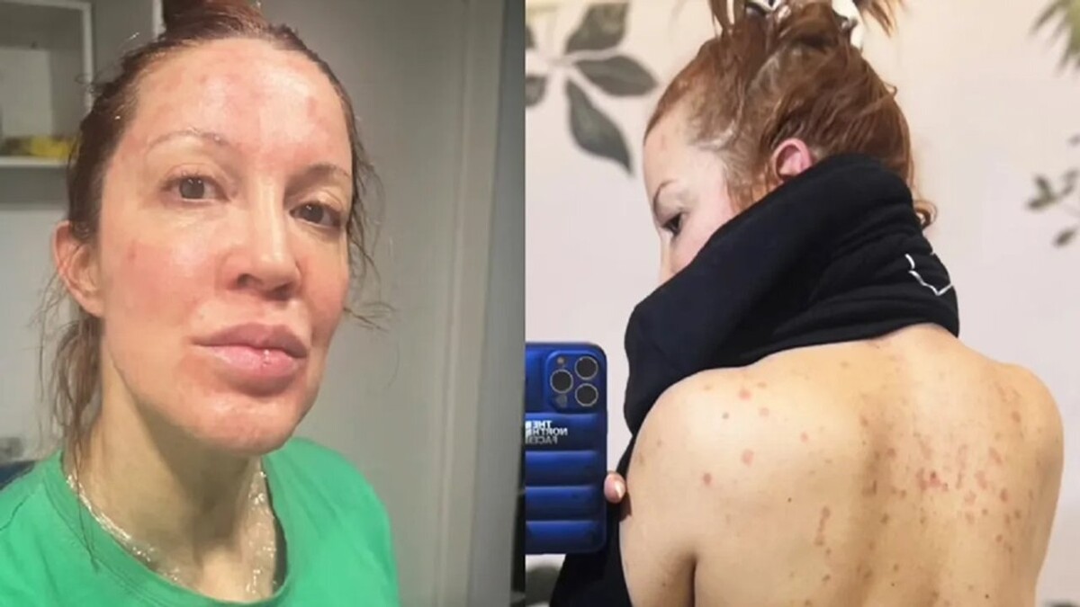 Actress Miriam Lanzoni opens up about her battle with psoriasis