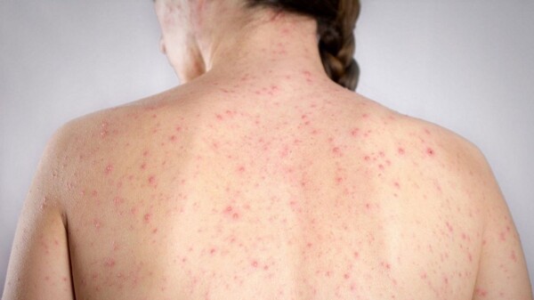 В Аргентину въехали четыре случая кори