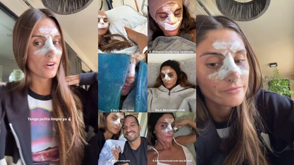 Lola Latorre Shares Her Nose Surgery Experience