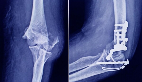 ANMAT advierte por tornillos falsificados en cirugías