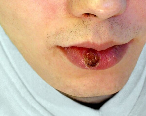 Сифилис возвращается в Аргентине на фоне сворачивания государственных программ